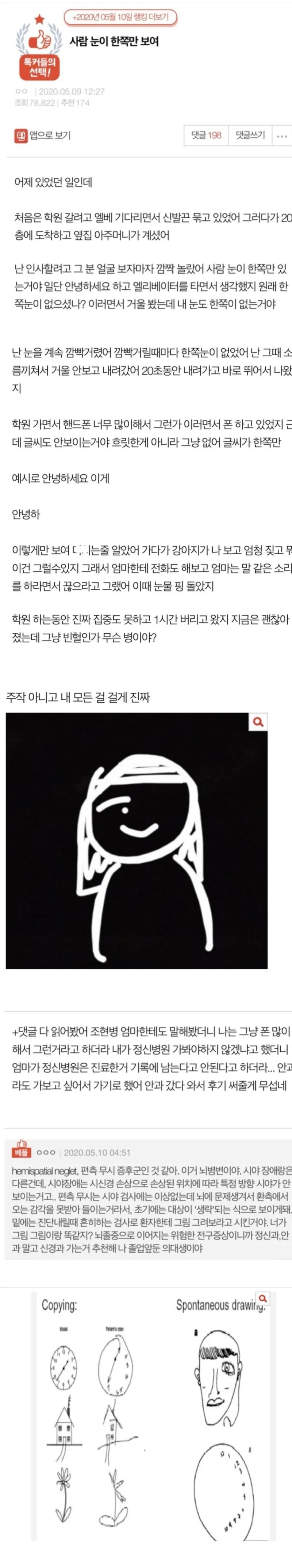 사람 눈이 한쪽만 보이는 병_1.webp