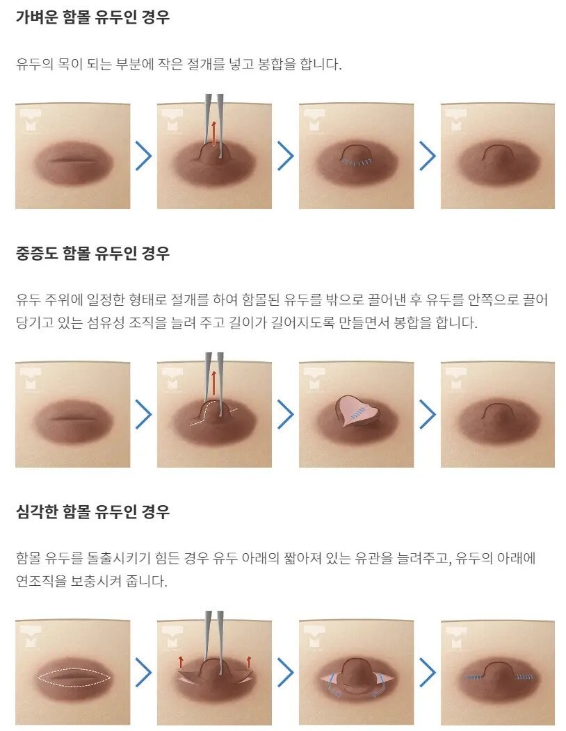 다양한 유두 성형 수술법.jpg_2.jpg