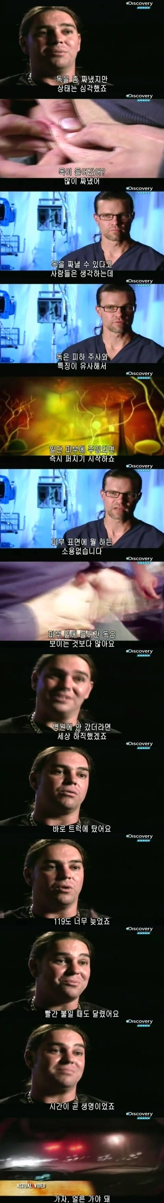 [극혐] 코브라한테 물려 배에 구멍이 뚫린 사람.jpg_4.jpg