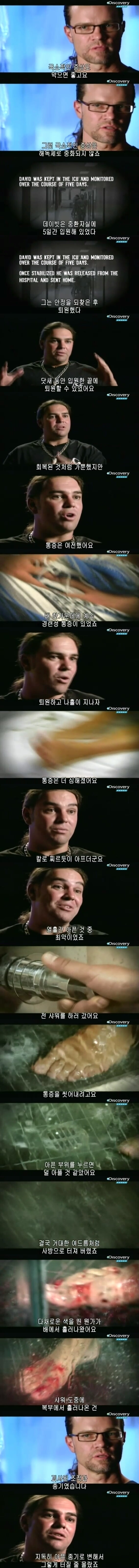 [극혐] 코브라한테 물려 배에 구멍이 뚫린 사람.jpg_9.jpg