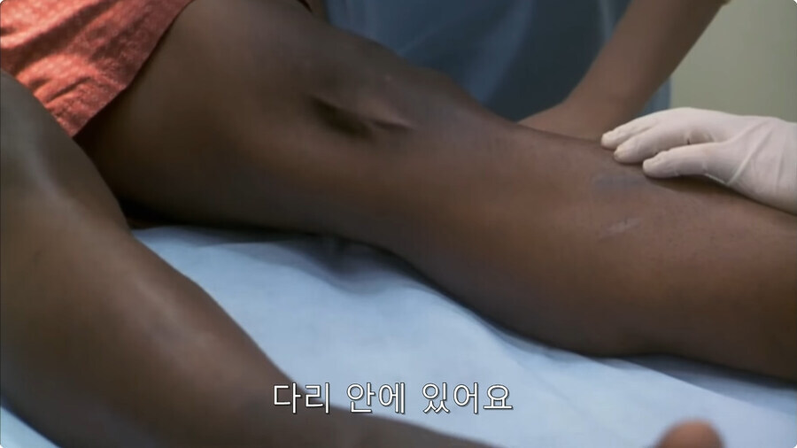 괴생명체를 제거하려면 다리를 절단해야 해요.jpg_1.jpg