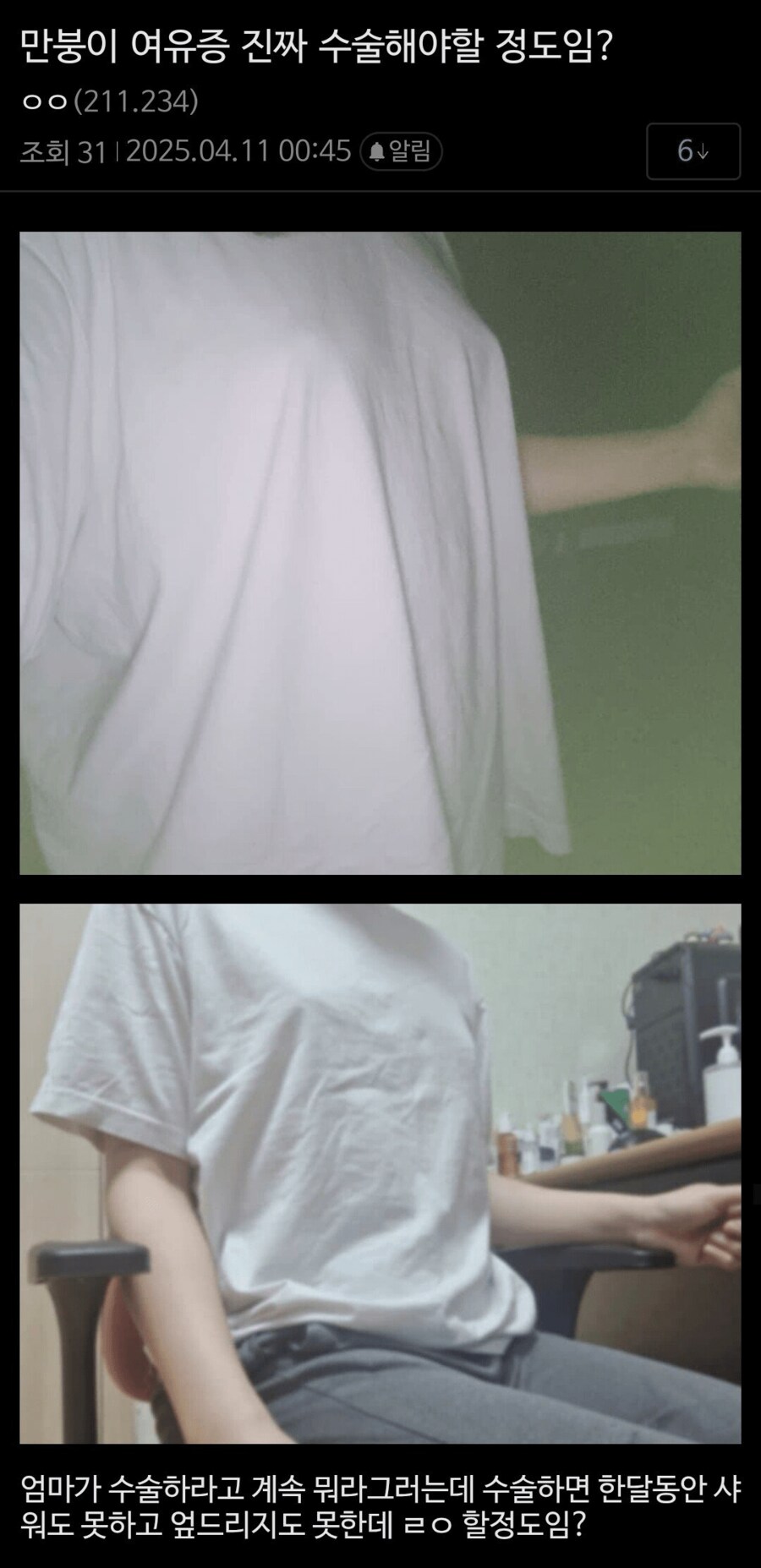 여유증 수술해야 할 정도인지 궁금한 사람.jpg_1.png