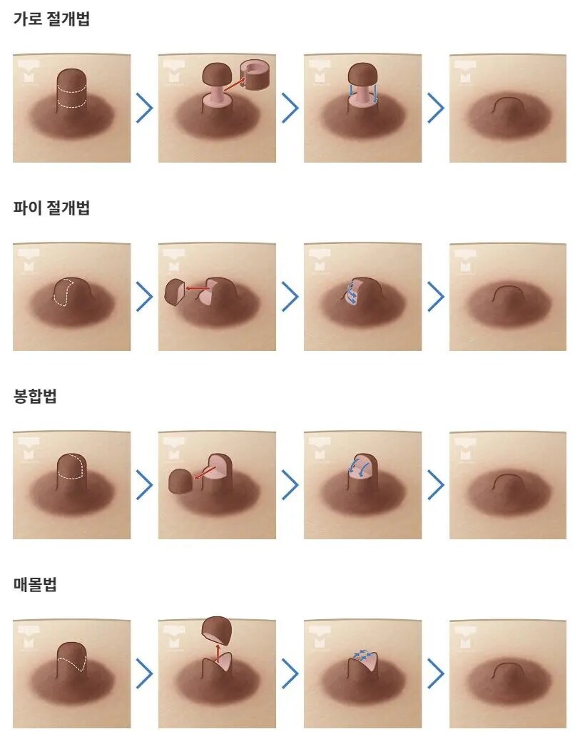 유두 시술법_1.jpg