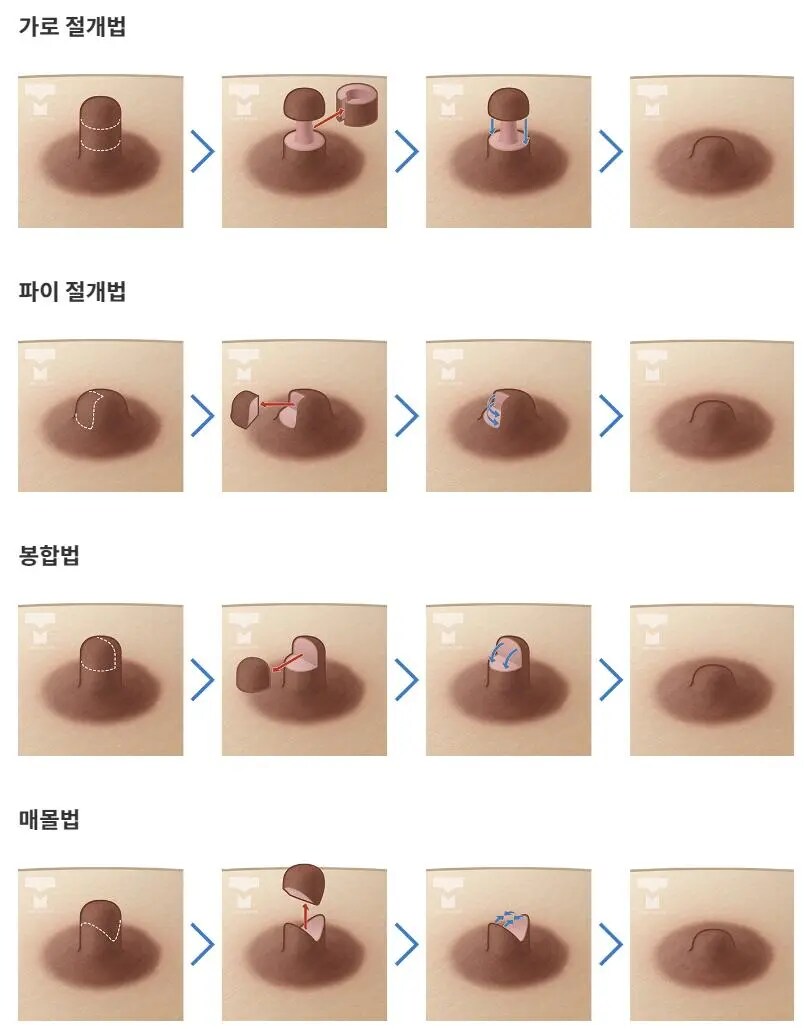 유두 수술 방법_1.png