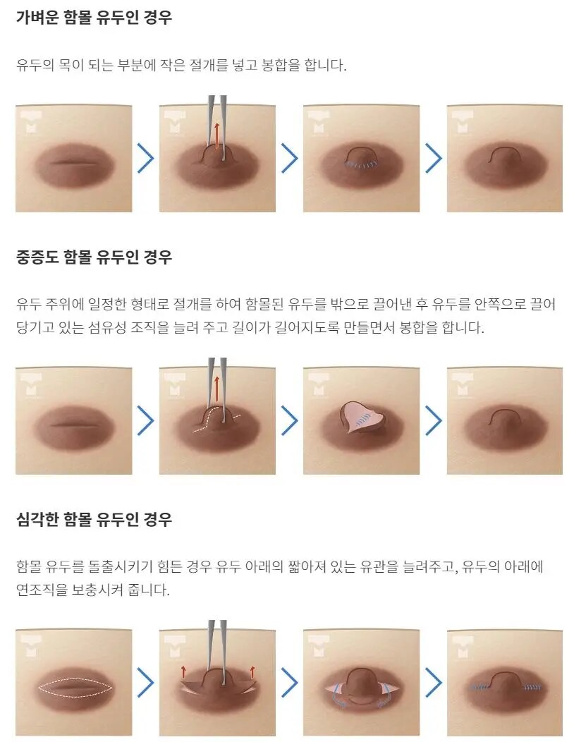유두 수술 방법_2.png