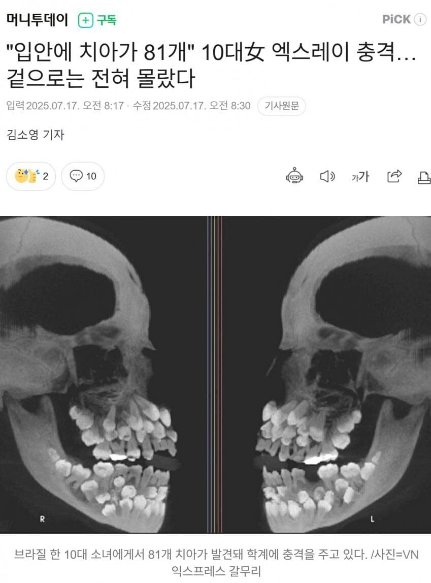 이빨많은 브라질 소녀_1.jpg