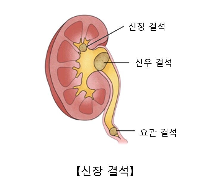 불과 반세기전만해도 죽을 수도 있었던 질병_1.png