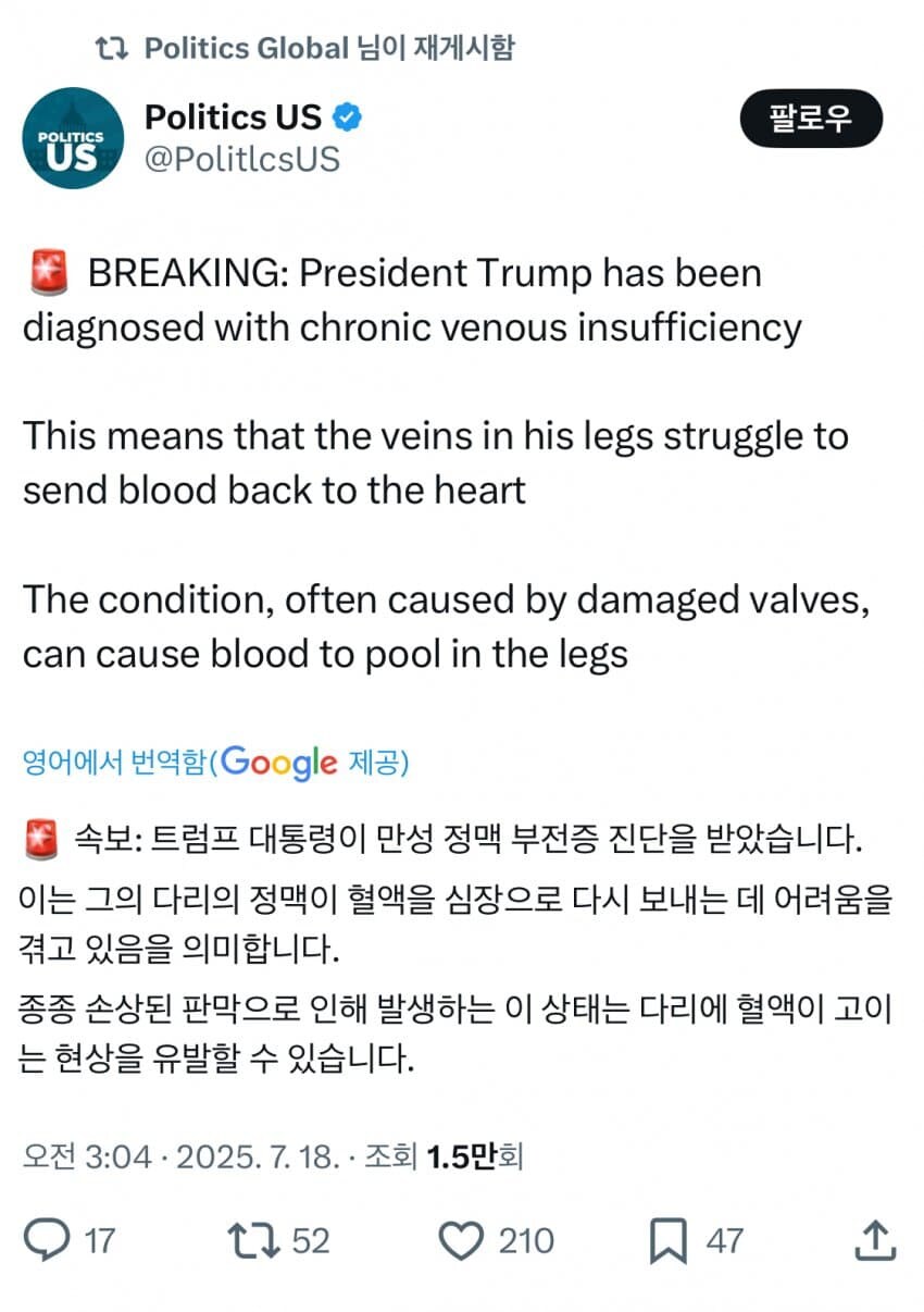 트럼프, 만성 정맥부전증 진단_1.jpg