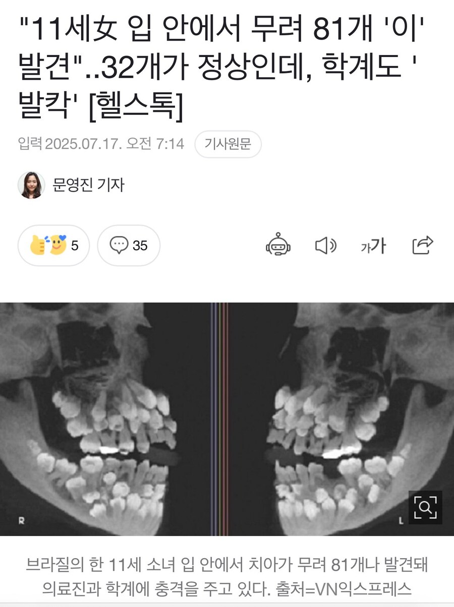 치아가 81개 발견된 사람ㄷㄷ_1.jpg
