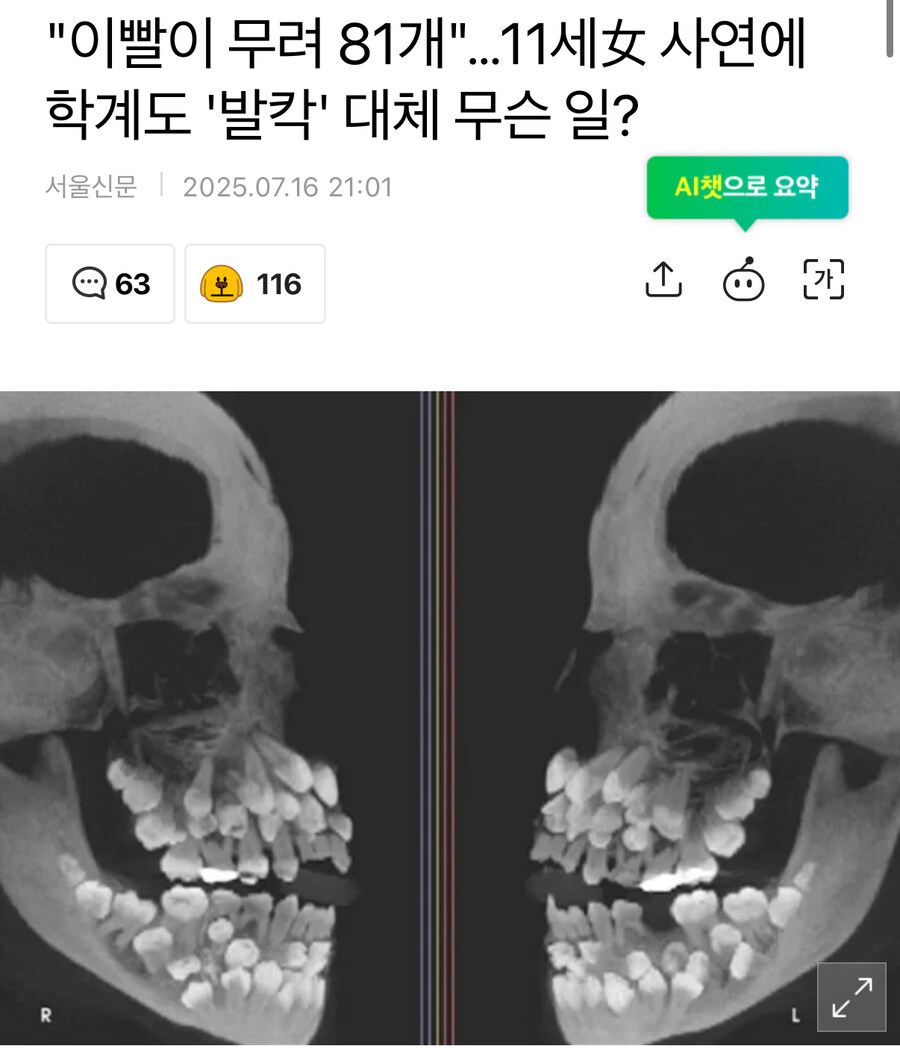 이빨이 무려 81개, 브라질 11세 소녀_1.jpg