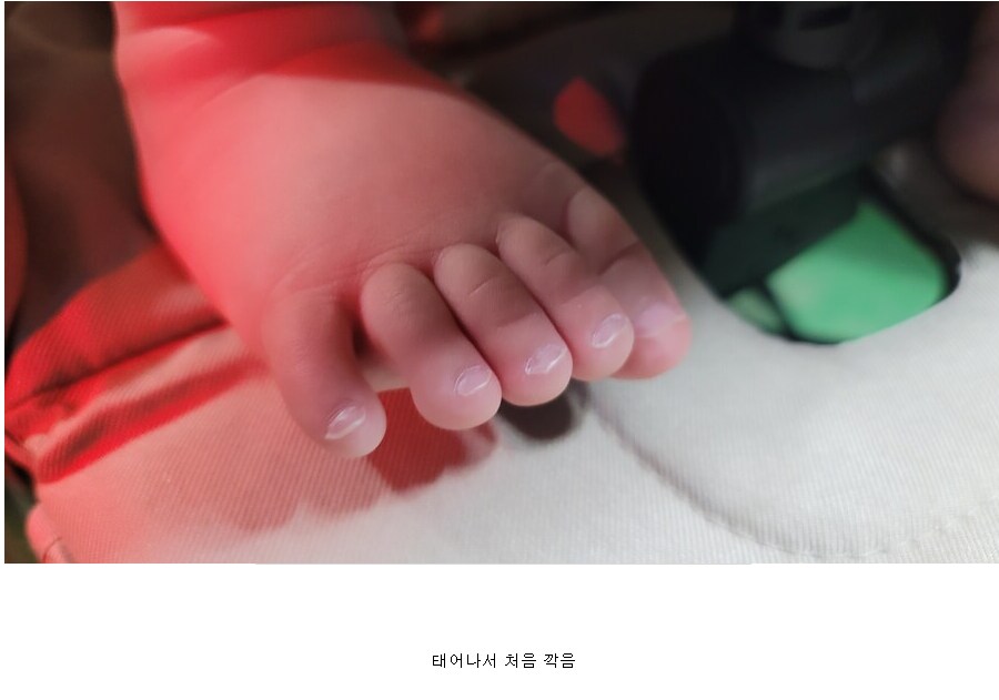 태어나서 처음 발톱을 깍았다는 여자의 발 상태 jpg_1.png