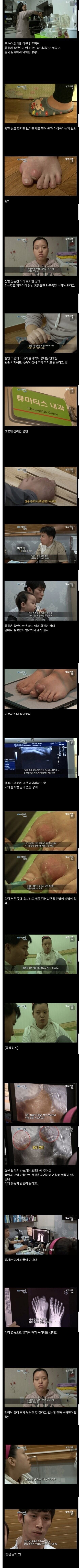 통풍 참고 살았다 발가락 뼈가 녹아 없어진 환자_1.png