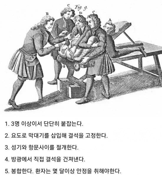 옛날 요로결석 치료법_1.jpg
