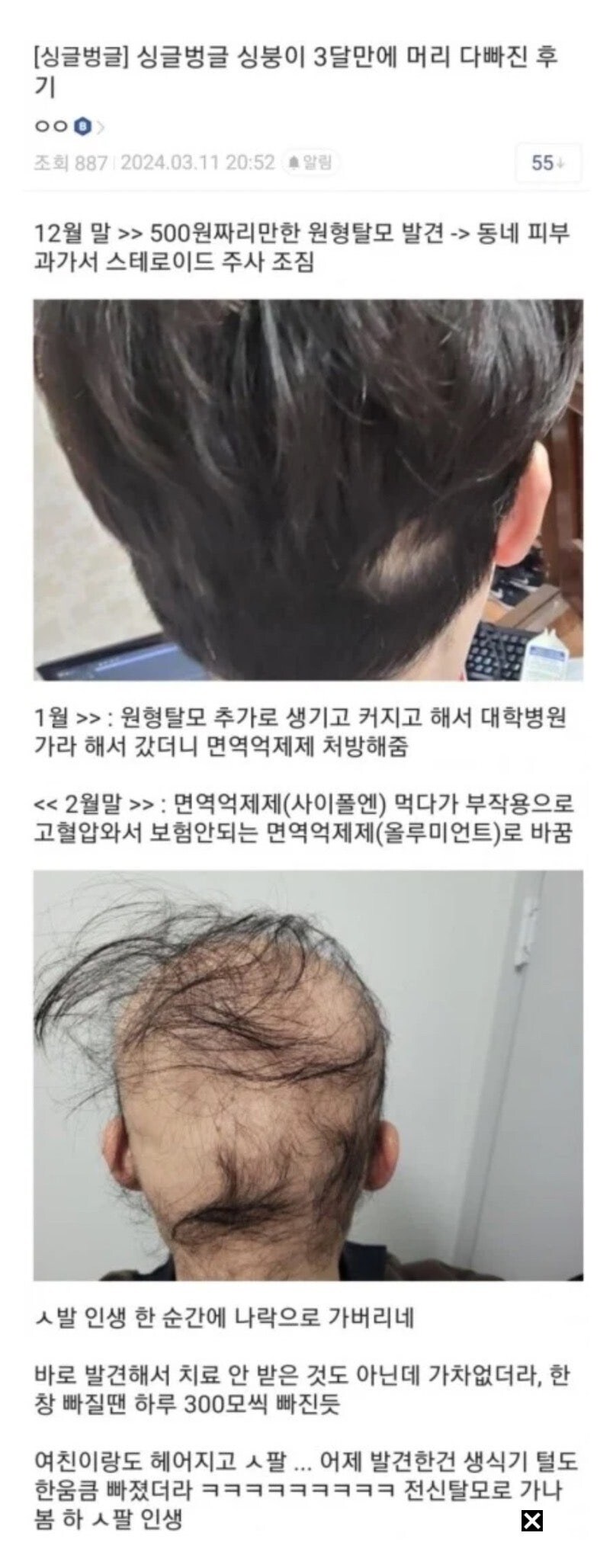디시 탈모 레전드.jpg_1.jpg