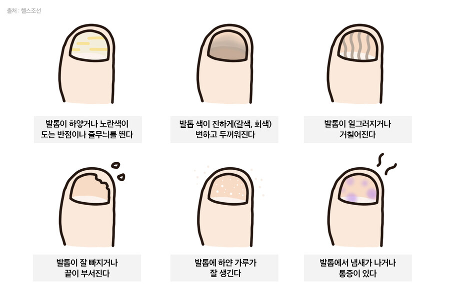 내성발톱인데 발톱교정기로 해결이 안 되는 이유_2.jpg