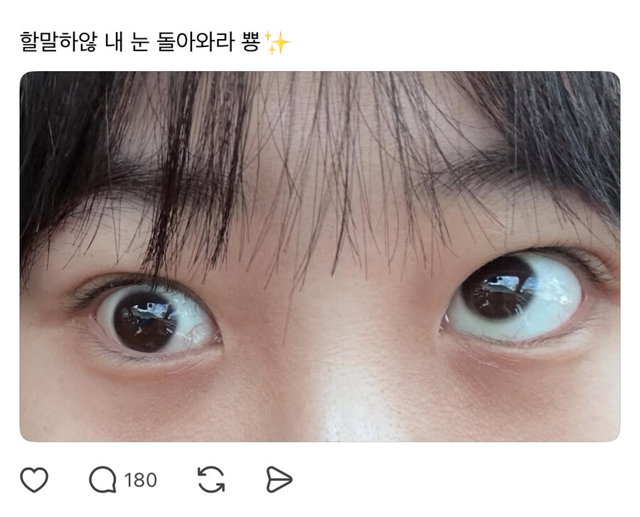 눈밑 지방제거술 하고 사시가 된 사람_2.jpg