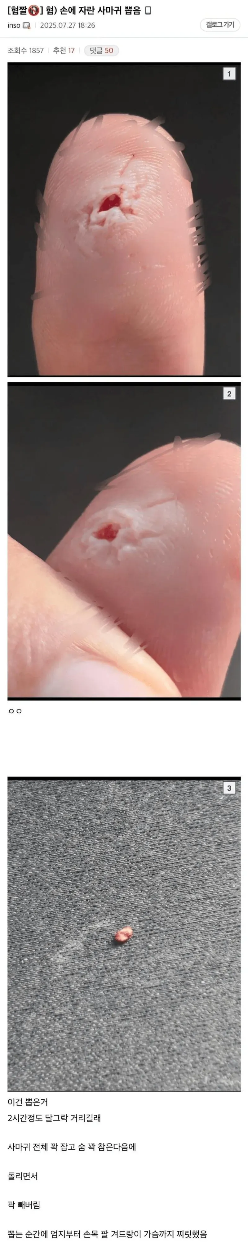 혐) 손에 자란 사마귀 뽑음_1.webp
