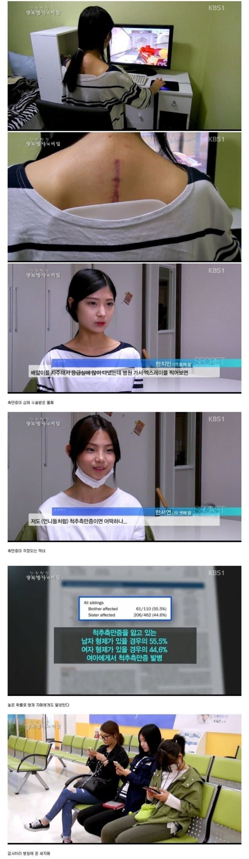 유전자의 무서움 척추측만증 세자매_2.jpg