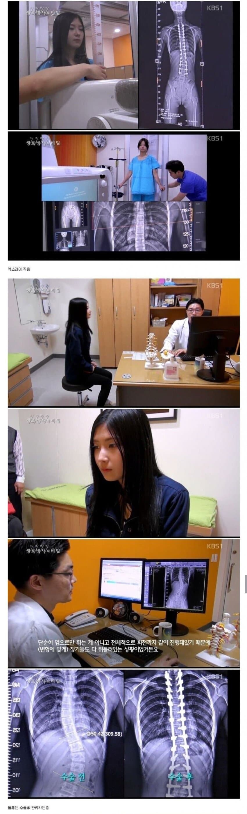 유전자의 무서움 척추측만증 세자매_3.jpg