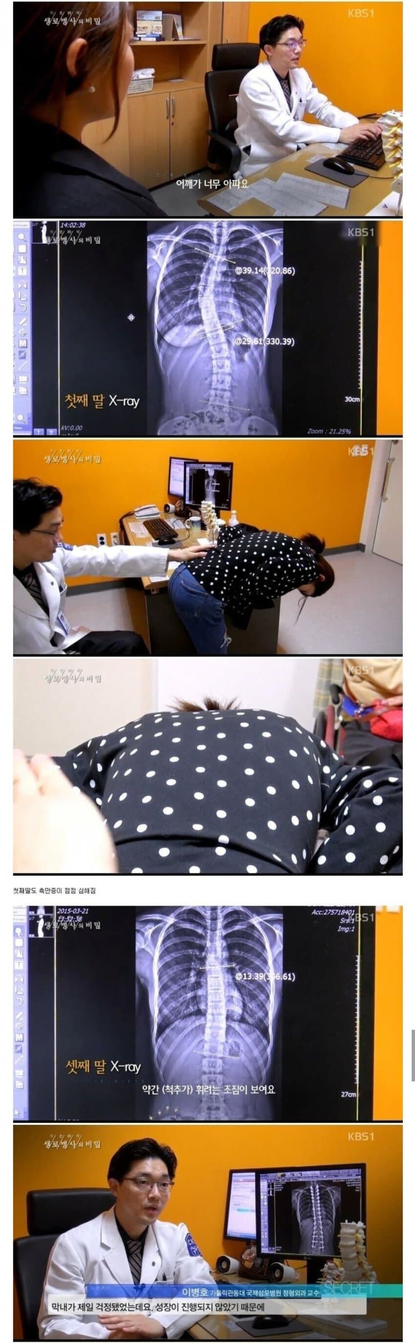유전자의 무서움 척추측만증 세자매_4.jpg