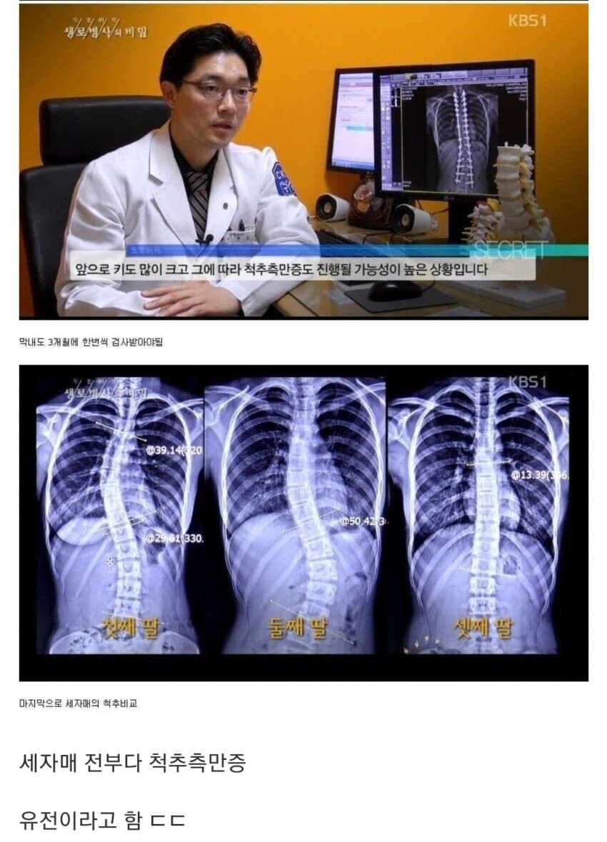 유전자의 무서움 척추측만증 세자매_5.jpg