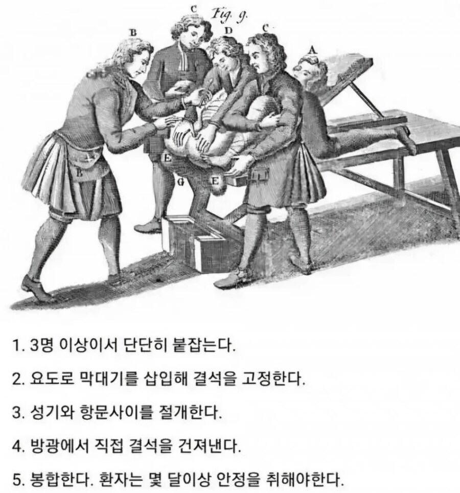 요로결석 수술 방법.jpg_1.jpg