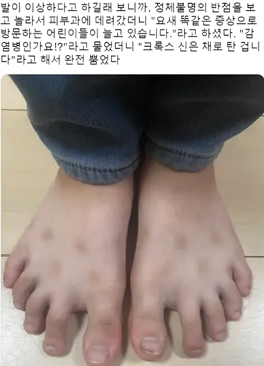 여름철 아이들이 겪는 유행병_1.png