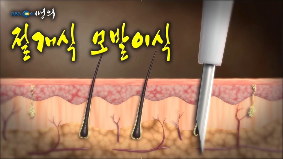 모발 이식_1.png