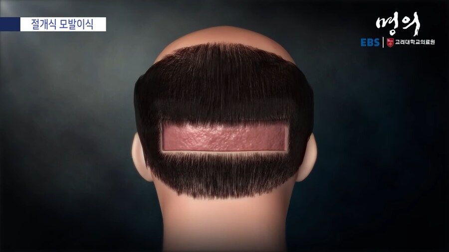 모발 이식_4.png