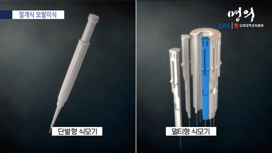 모발 이식_11.png
