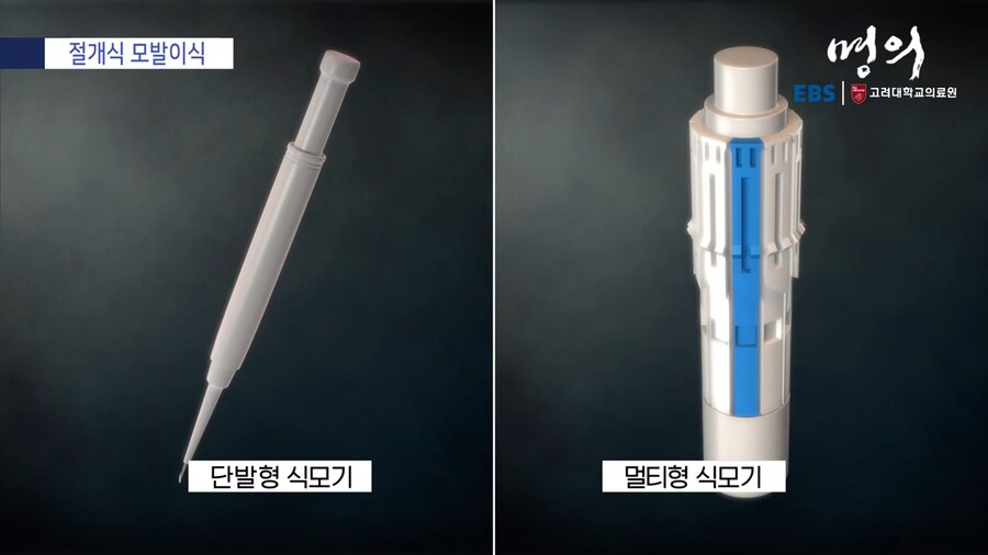 모발 이식_12.png