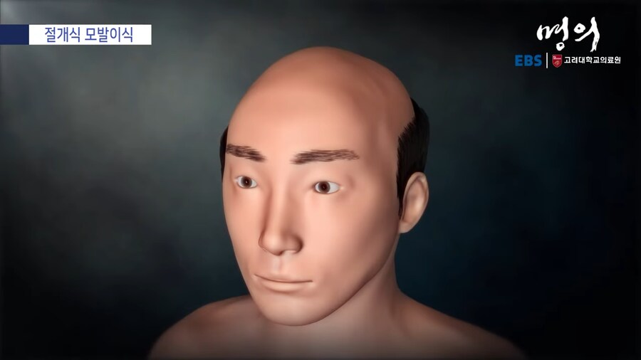 모발 이식_25.png