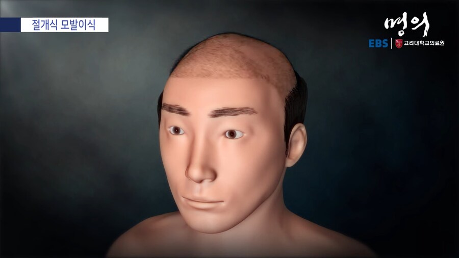 모발 이식_26.png