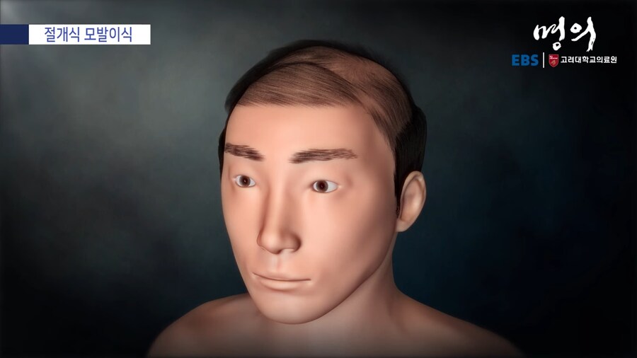 모발 이식_27.png