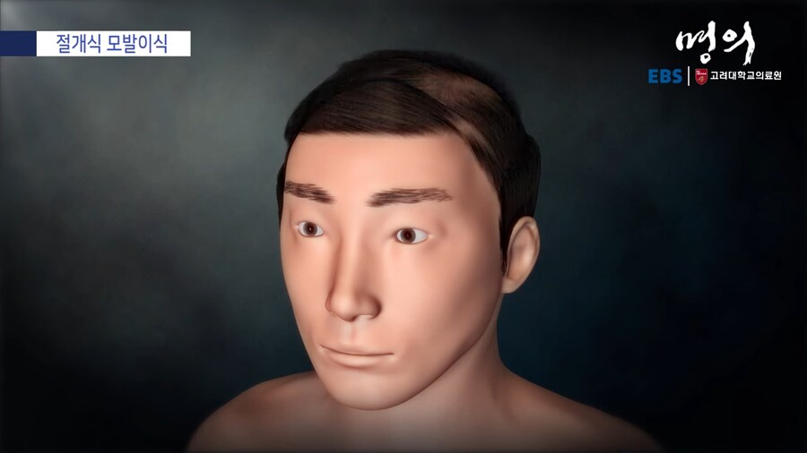 모발 이식_28.png