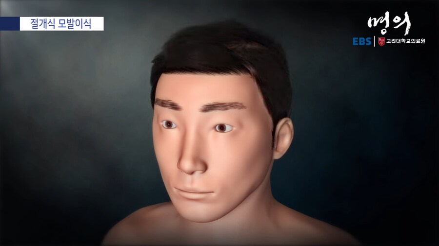 모발 이식_29.png