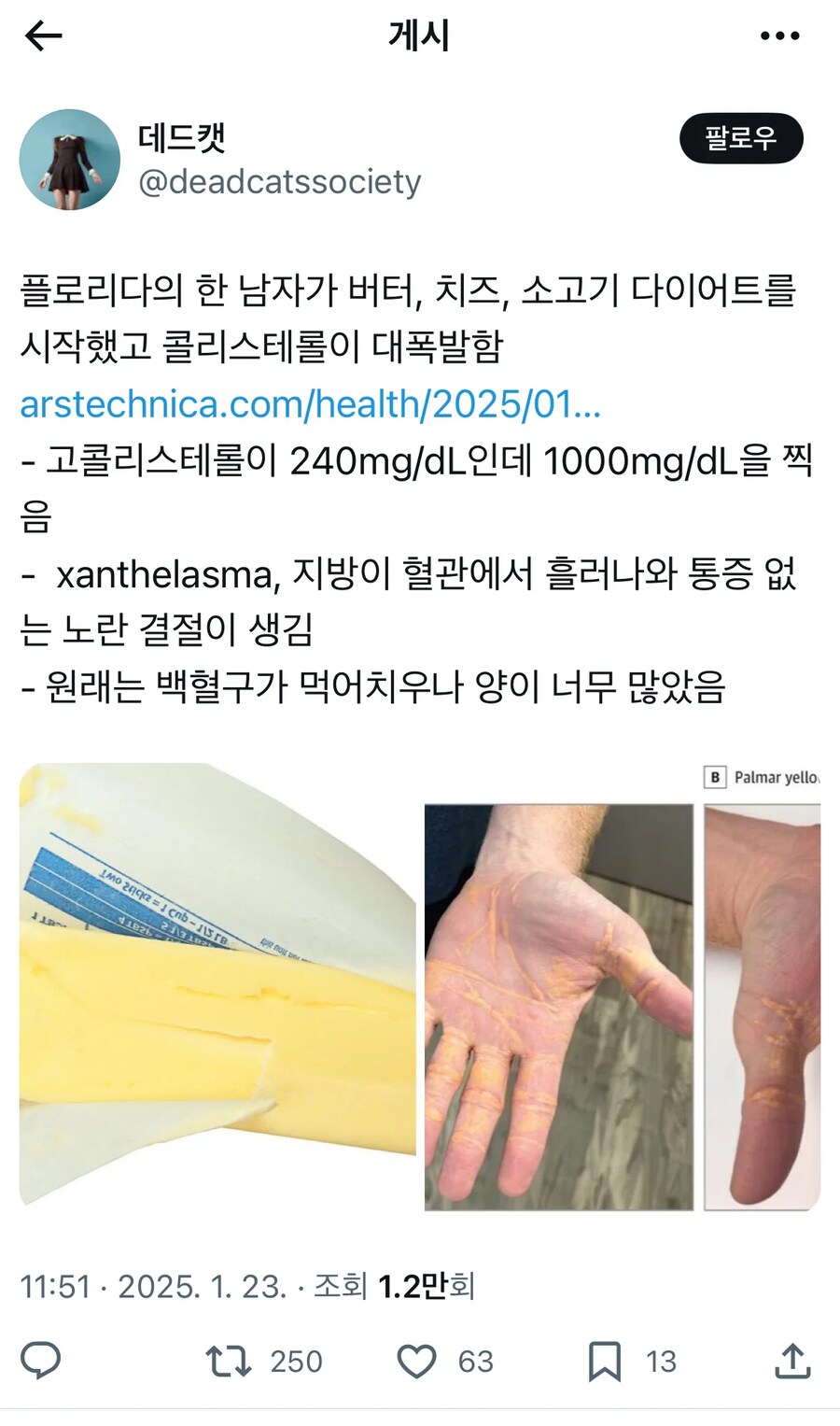저탄고지 다이어트를 한 플로리다 남자_1.png