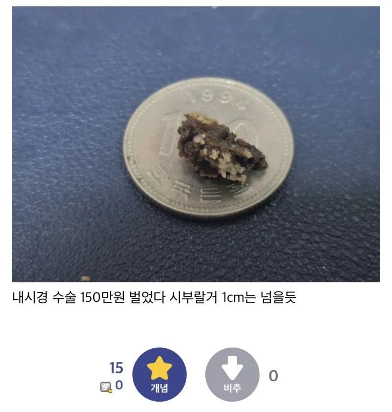 역대급 크기의 결석을 자연배출한 디시인…._2.webp