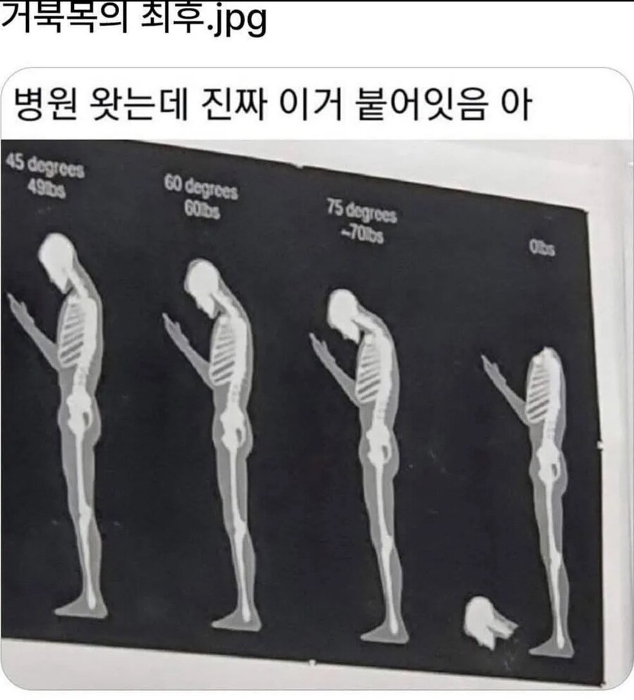거북목의 최후_1.png