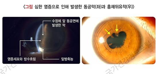 안과의사가 귀멸 영화에 집중못한 이유_3.jpg