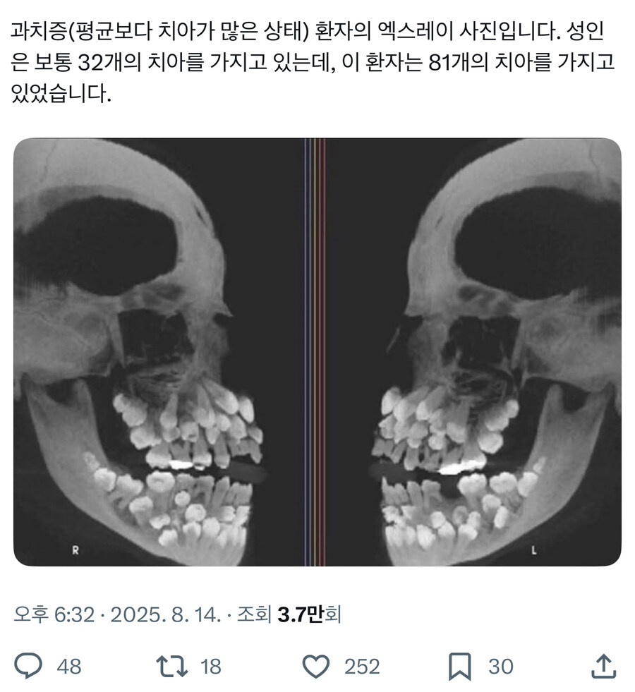 약혐) 흔한 과치증 환자의 이빨상태.jpg_2.jpg