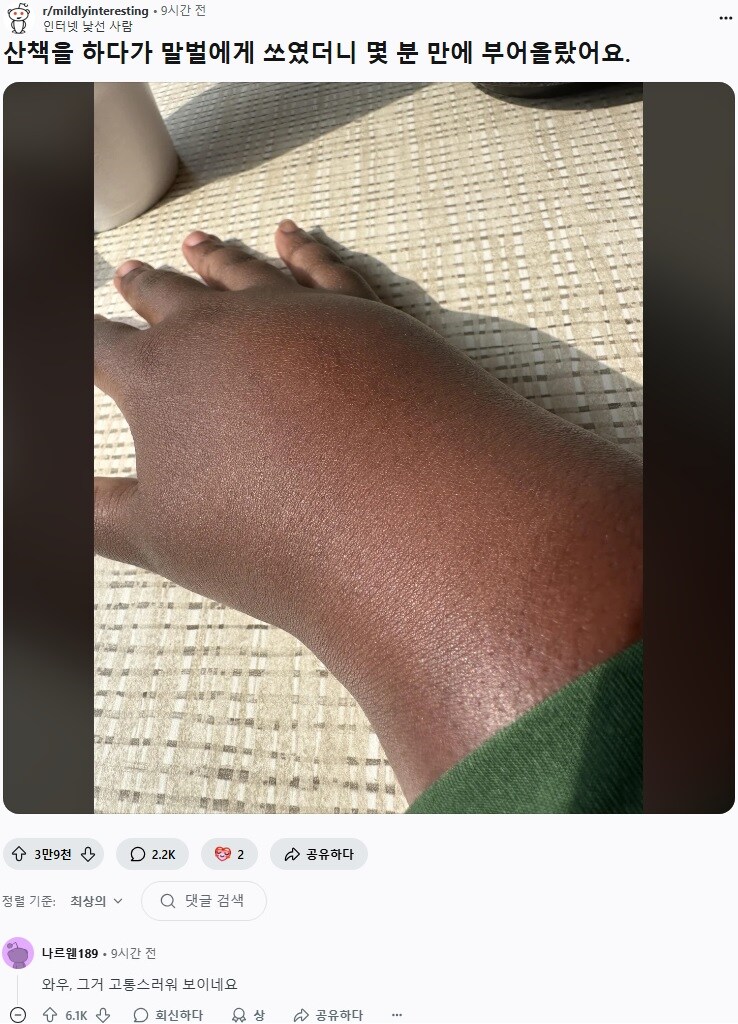 산책하다가 말벌에 쏘인 사람_1.png