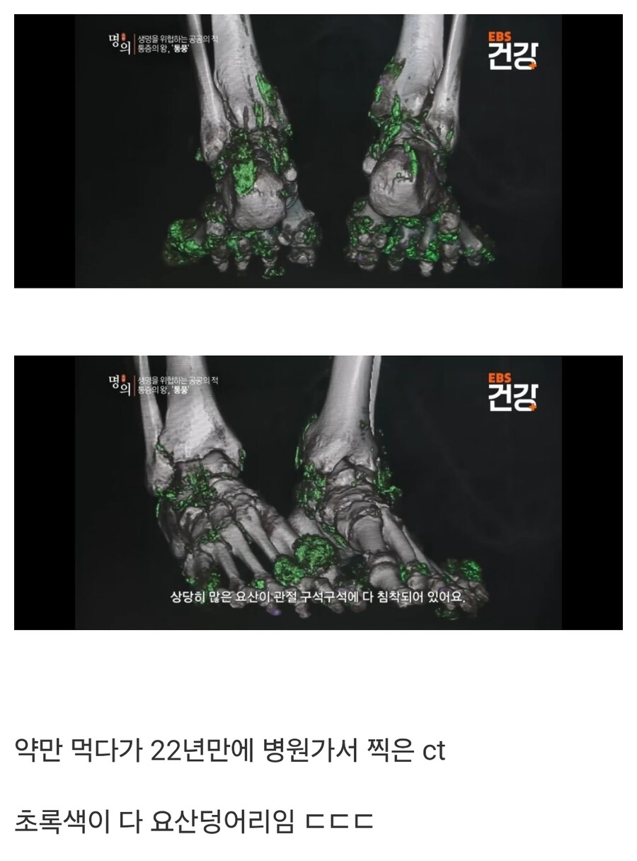 22년동안 통풍 관리 안한 발 CT 사진 .. ㄷㄷ_1.jpg