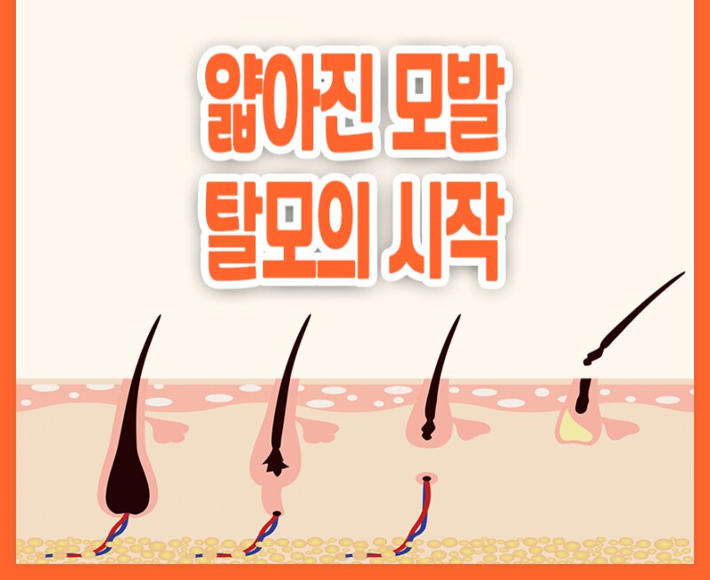 진짜 존나 위험한 단계인 탈모 증상.png_1.png