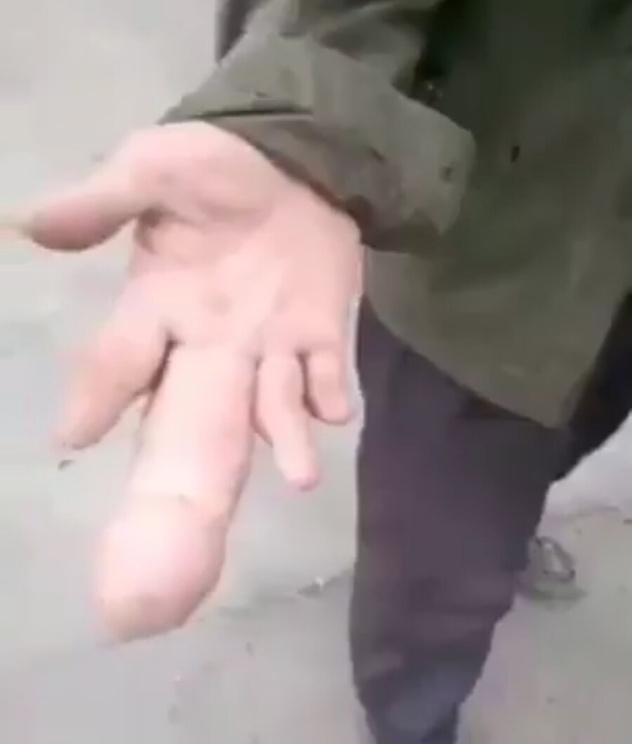신체 일부가 거대해지는 희귀병, ‘국소적 거대증‘_1.jpg