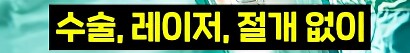 라식, 라섹은 끝났다 시력교정 게임체인저_2.png