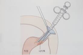 엉덩이에 넣으면 안 되는 거.jpg_4.jpg