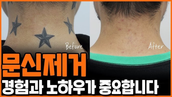 문신제거 노하우가 중요한 이유_1.jpg