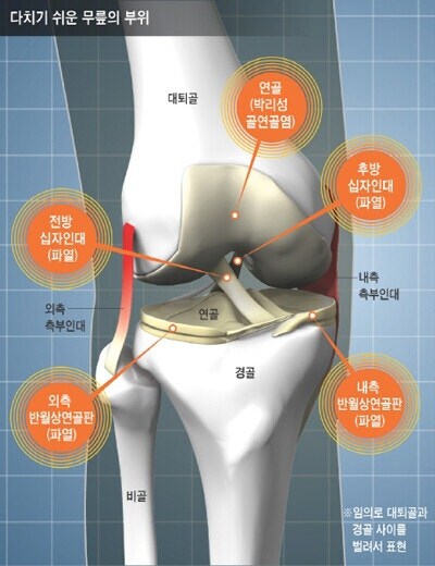 뼈나 인대 다쳐본 사람이 공감하는 점.jpg_2.jpg
