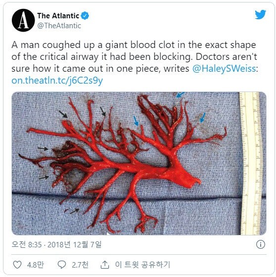 약혐)재채기 하다가 나온 피떡.jpg_1.jpg